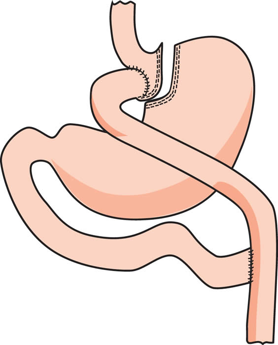 bypass gastrico